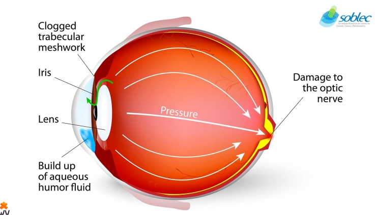 Quais são os sintomas do glaucoma de ângulo aberto?